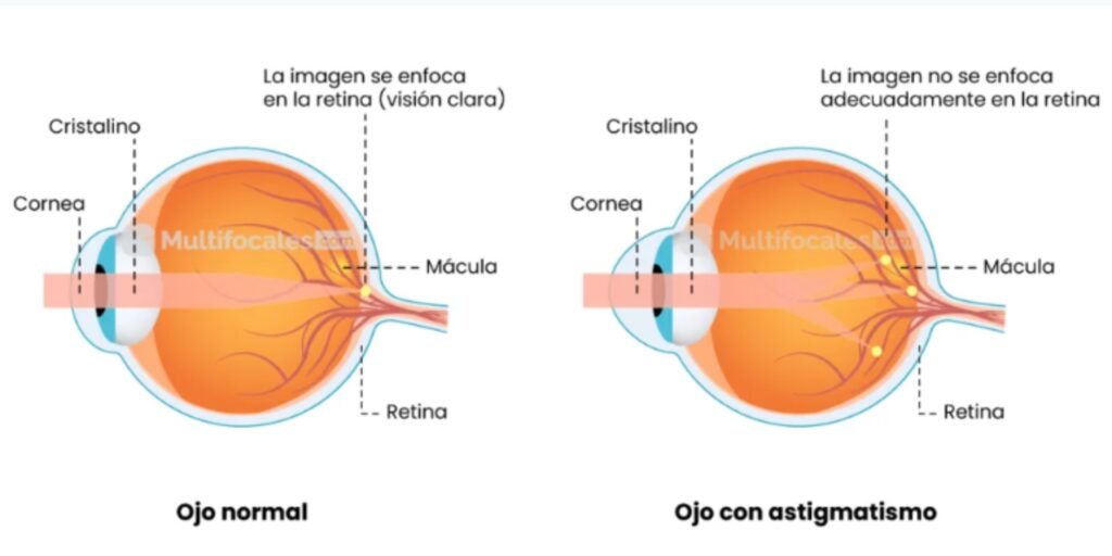 ojo con astigmatismo