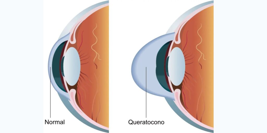 ojo con queratocomo