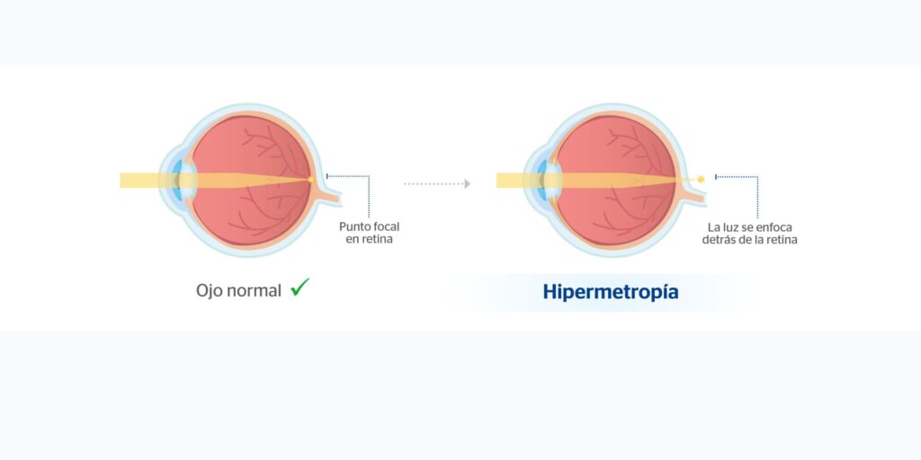 ojo con hipermetropia