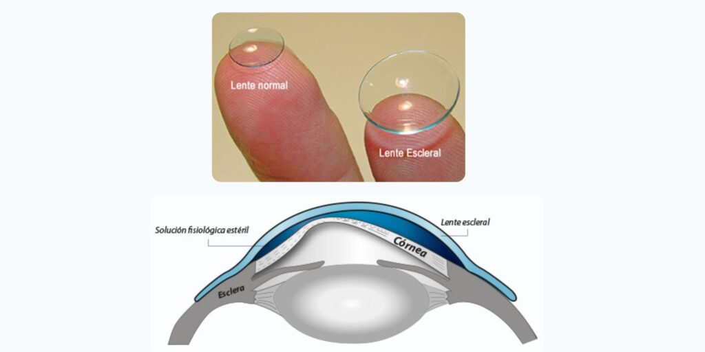 lentes de contacto esclerales